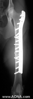 Follow-up X-ray