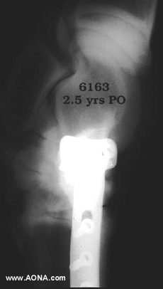 2 1/2 year follow-up radiograph