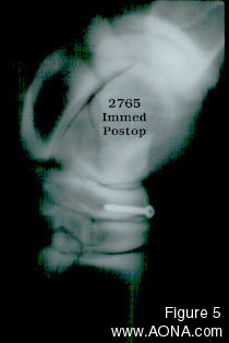 Figure 5: immediate postoperative radiograph