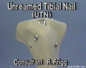 Unreamed Tibial Nail