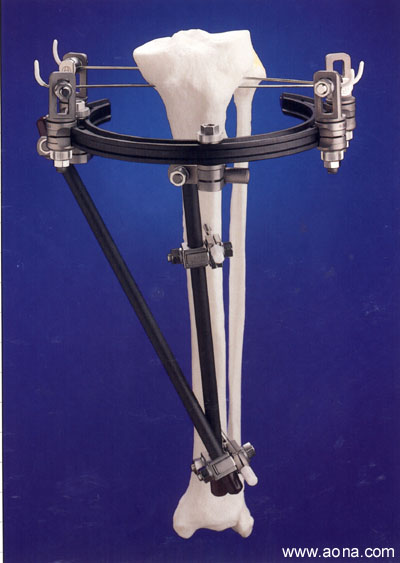 The Ao Asif Hybrid Fixator Technique Guide Orthopaedic Surgery 6156