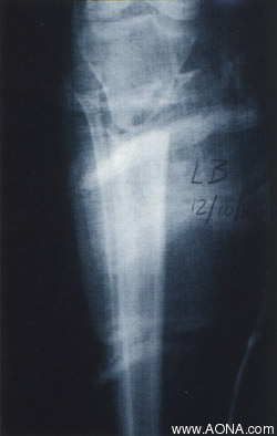 Indications:  Stabilization of soft tissues and fractures