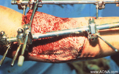 Indications: Stabilization of soft tissues and fractures