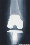 Arthrodeses and Osteotomies with Soft Tissue Problems;  Failures of Total Joints