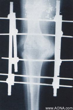 Indications: Arthrodeses and Osteotomies with Soft Tissue Problems;  Failures of Total Joints