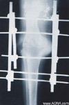 Arthrodeses and Osteotomies with Soft Tissue Problems;  Failures of Total Joints