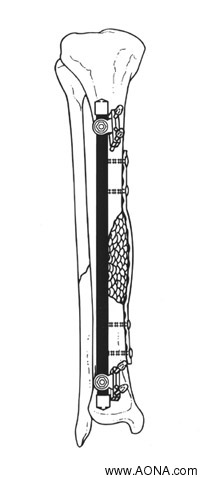 Indications: Neutralization of Fractures Stabilized with Limited Internal Fixation