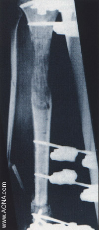 Unilateral Rectilinear Bone Segment Transport or Leg Lengthening