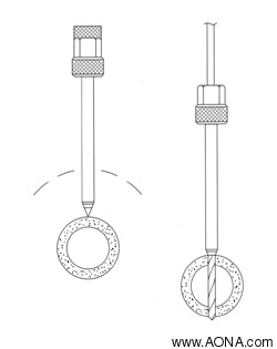 Basic Technique Principles.  Schanz Screw Insertion