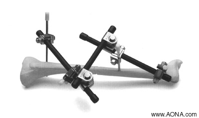 Modular Frame Technique. Fracture Reduction Can Be Adjusted