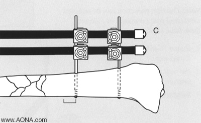 Frame Biomechanics - Factors that Increase Frame Stability