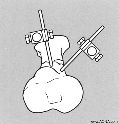 Examples of Additional Frames - One and Two Plane Unilateral Frames