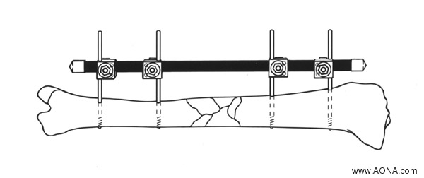 Examples of Additional Frames - One and Two Plane Unilateral Frames