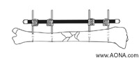 Frame Biomechanics - Examples of Additional Frames - One and Two Plane Frames