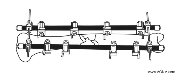 Examples of Additional Frames - One and Two Plane Unilateral Frames