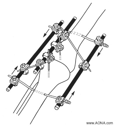 Examples of Additional Frames - Three Plane Frame