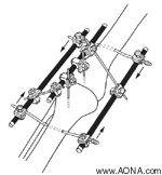 Frame Biomechanics - Examples of Additional Frames - Three Plane Frame