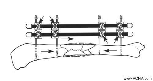 Dynamize the Frame, Double Stack the Frame, Crosswise Release