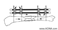 Double Stack the Frame, Crosswise Release