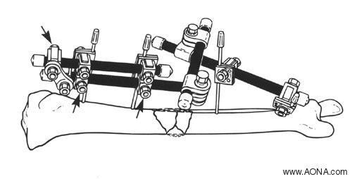 Dynamize the Frame, Double Stack the Frame, Crosswise Release