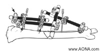 Double Stack the Frame, Crosswise Release