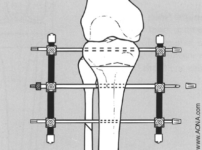 Insert and Attach Pin to Rod