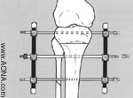 Insert and Attach Pin to Rod