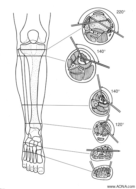 Customize the Frame Construction - Tibia. Insert Schanz Screws