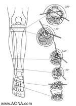 Customize the Frame Construction - Tibia. Insert Schanz Screws