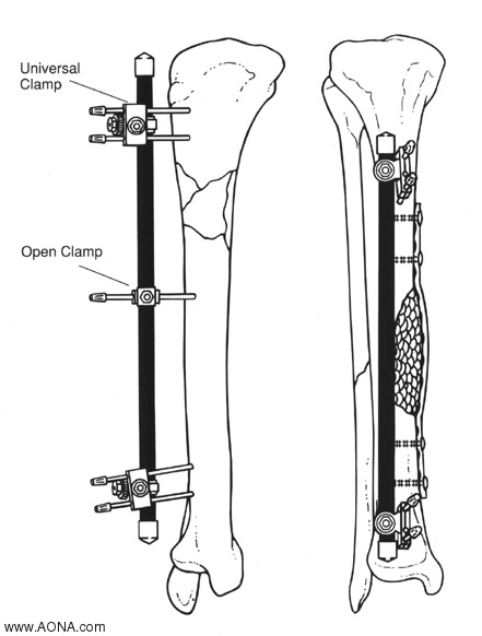 Customize the Frame Construction - Tibia - Unilateral Frames with Universal Clamps