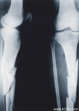 Tibia