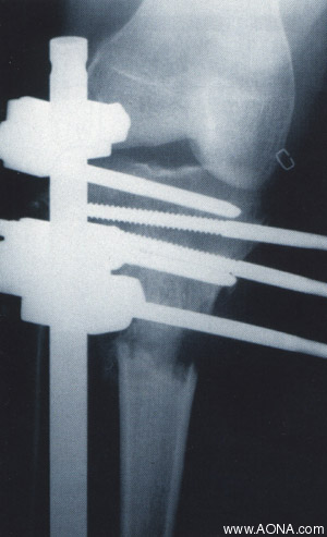 Tibia