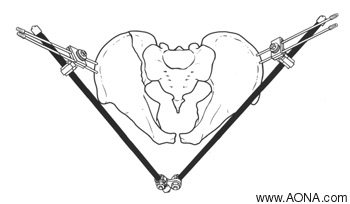 Pelvis - Resuscitation Frame