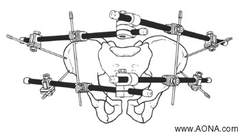 Pelvis - Double V Frame