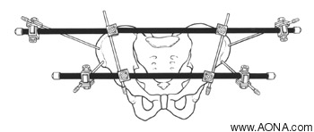 Double Rod Frame