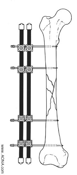 Femur - Double Bar Unilateral Frame