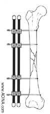 Double Bar Unilateral Frame