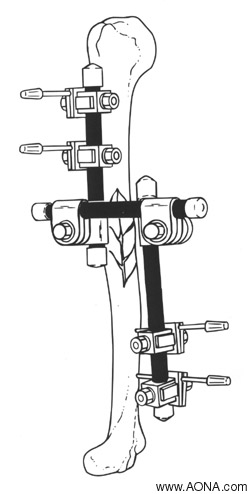 Humerus - Modular Frame