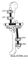 Humerus - Modular Frame