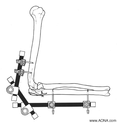 Modular Elbow Bridge