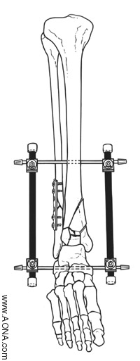 Modular Knee Bridge and Modular Ankle Bridge