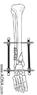 Modular Ankle Bridge