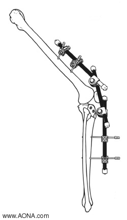 Modular Knee Bridge and Modular Ankle Bridge