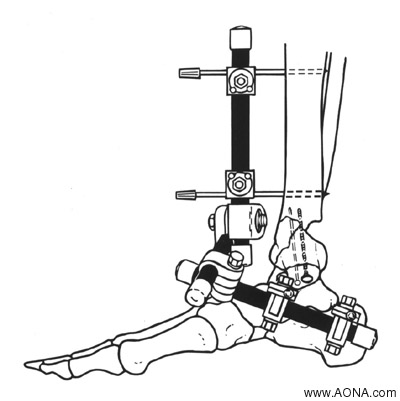 Modular Knee Bridge and Modular Ankle Bridge