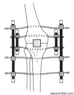 Arthrodeses - Bilateral Knee Frame and Bilateral Ankle Frame