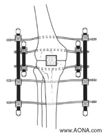 Bilateral Knee Frame and Bilateral Ankle Frame