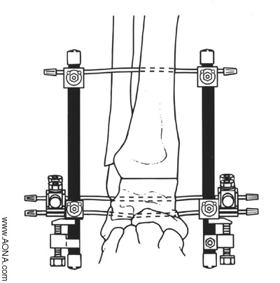 Arthrodeses - Bilateral Knee Frame and Bilateral Ankle Frame