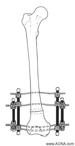 Nonunions and Malunions - Bilateral Nonunion Frame