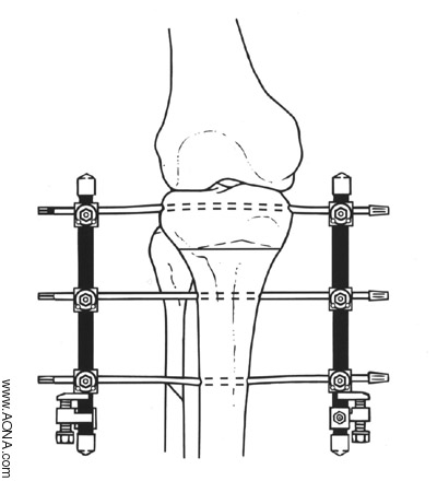 Osteotomies