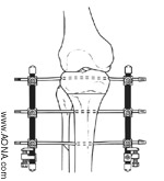 OSTEOTOMIES